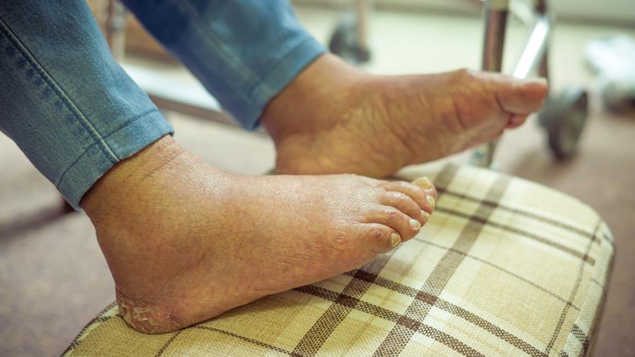 Eosinofiele fasciitis: een zeldzame bijwerking van checkpointremmers
