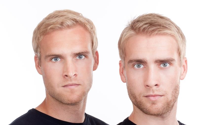 Pourquoi de vrais jumeaux ne réagissent-ils pas de la même manière aux infections ?