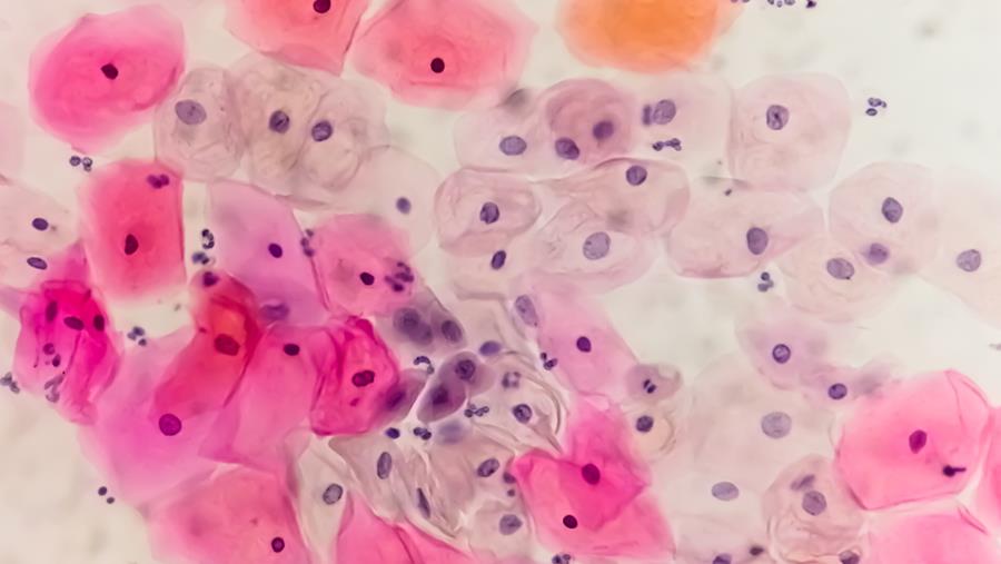 HPV-infectie met hoog risico: nut van topische behandelingen?