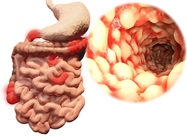 Maladie de Crohn : modèle de risque pour les parents de premier degré