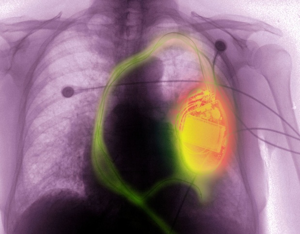 Cardiologen plaatsen nieuw type minipacemaker dat voor bijna iedereen geschikt is