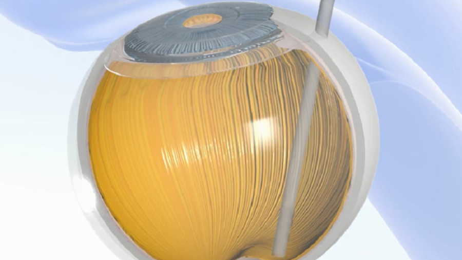 Elektronisch oogimplantaat lost probleem van netvliesslijtage op