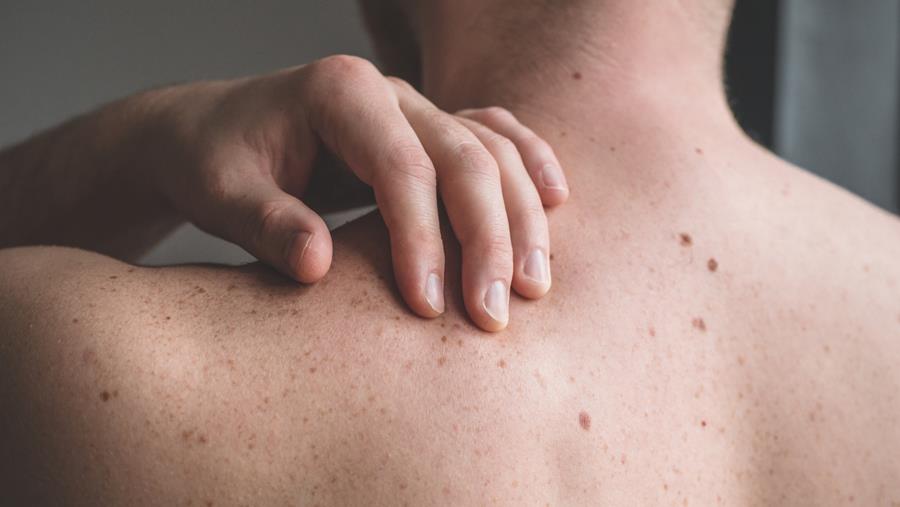 KU Leuven ontdekt molecule die immuuntherapie tegen huidkanker afremt