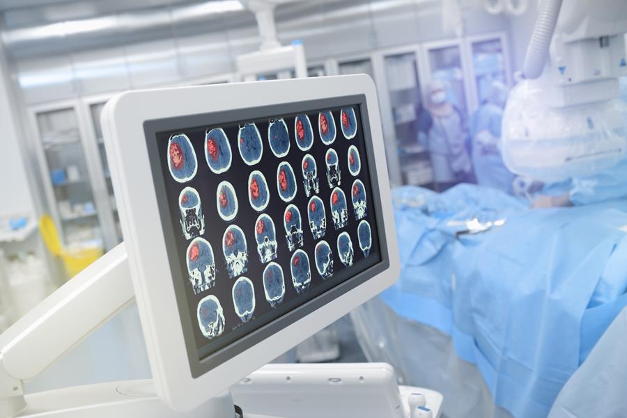 AVC ischémique : des progrès, mais encore des disparités entre hôpitaux