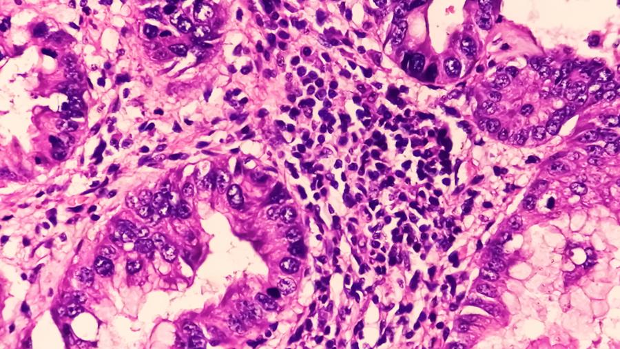 Naar een betere opsporing en diagnose van prostaatkanker