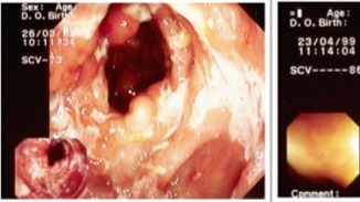 Maladie de Crohn nouvellement diagnostiquée : quel est le phénotype des patients et comment sont-ils traités ?