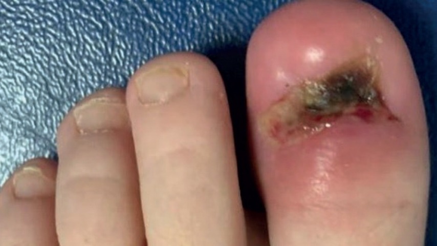 Mycoplasma hominis-osteomyelitis van een teen: kleine oorzaak, grote gevolgen