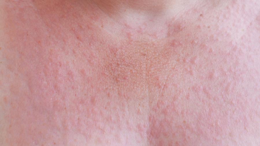 L’allergie solaire liée au microbiome cutané