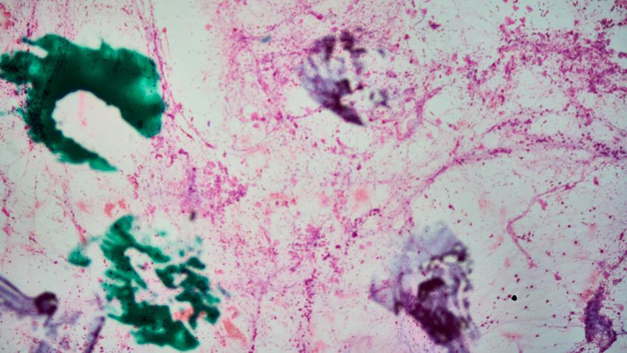 HARMONi-6 : l’ivonescimab redéfinit la première ligne du carcinome épidermoïde bronchique avancé