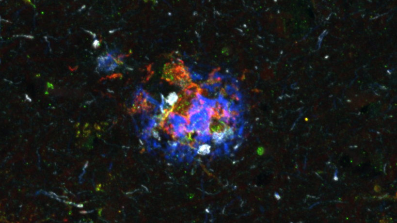 Un point de bascule critique dans la maladie d’Alzheimer identifié