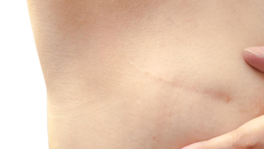 Les données à cinq ans de SENOMAC confortent l’omission du curage axillaire